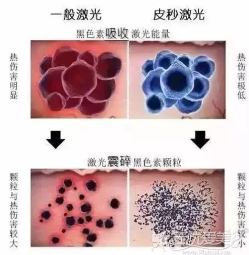北京丽都介绍蜂巢皮秒祛斑的过程