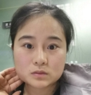 在韩国艾恩做轮廓手术后又做了眼、鼻综合和面部脂肪填充