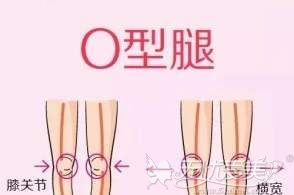 上海丽质各种o型腿矫正方法让你上午做完下午上班