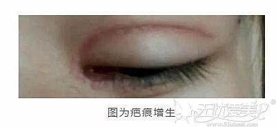 魏广运对双眼皮术后疤痕增生的修复优势