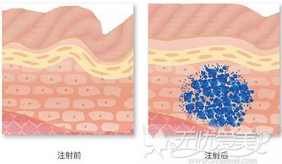 馨妍玻尿酸的优势和维持时间