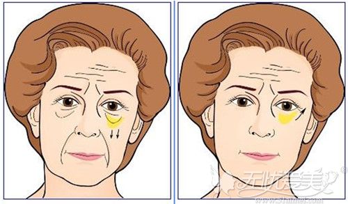 眶隔释放手术前后效果对比
