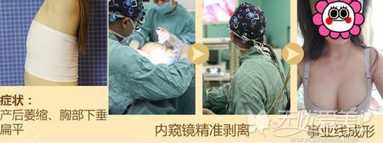 重庆艺星假体隆胸手术案例