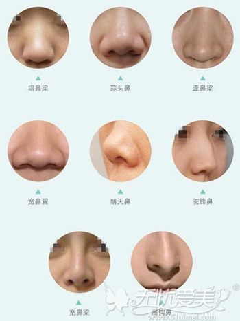 从这几张丑鼻图片中你就该明白做鼻综合是多么重要！