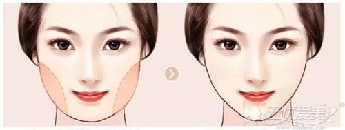重庆时光整形面部吸脂是可以让你快速瘦脸的好办法