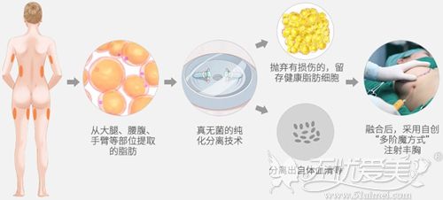 南昌艾莱芙吸脂和脂肪丰胸手术一次搞定