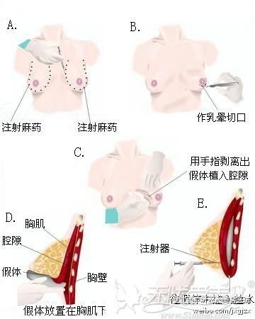 假体隆胸的过程