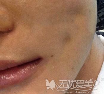 对于面部吸脂后出现的皮肤粘连哈尔滨雅美会如何修复？
