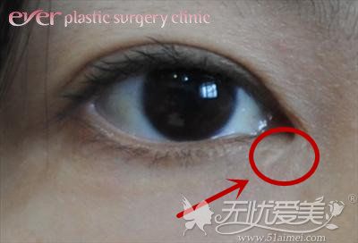 内眼角手术失败留疤问题可到韩国爱源整形解决