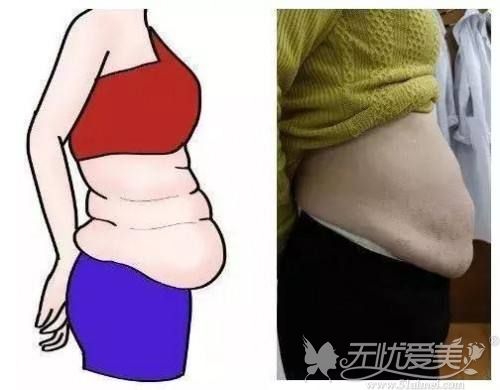 产后腹部松弛可以做腰腹部吸脂手术