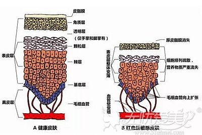 韩国施丽美羕的赛诺秀双波长染料激光去红血丝大受欢迎