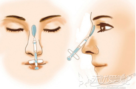 杭州连天美三种隆鼻手术帮你摆脱塌鼻梁
