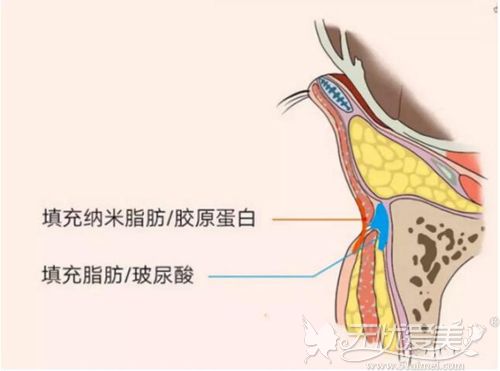 玻尿酸和胶原蛋白填充泪沟的位置