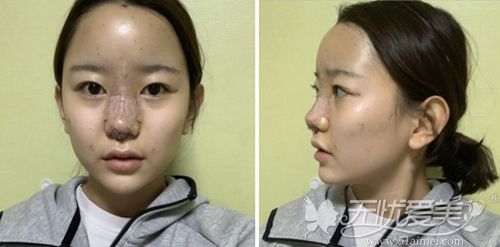 在韩国艾恩做鼻综合和全脸脂肪填充手术当天