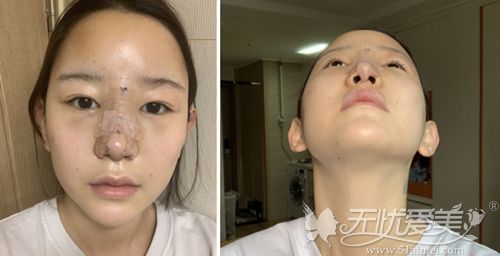在韩国艾恩做鼻综合和全脸脂肪填充后3天