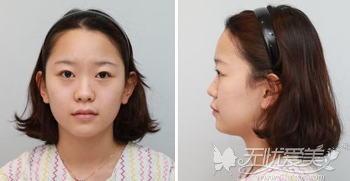 在韩国艾恩做鼻综合和全脸脂肪填充术前