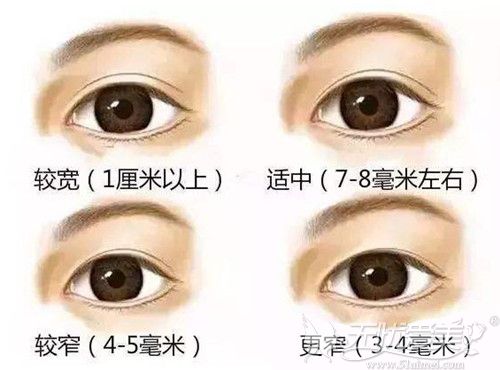佛山华美介绍双眼皮手术不同的宽度