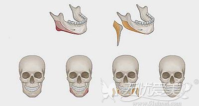 在上海美联臣做完下颌角手术后截骨部位还没有做肋骨鼻疼