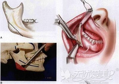 做下颌角手术需要将骨骼和软组织进行剥离