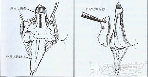 阴蒂整形手术原理