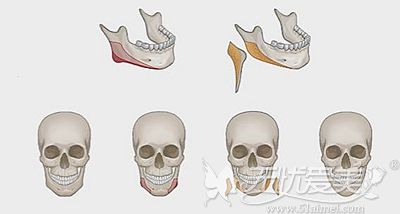 解析下颌角手术的设计理念