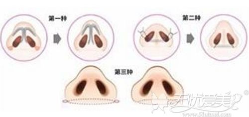鼻翼缩小的三种方法