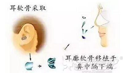 耳软骨隆鼻的手术原理