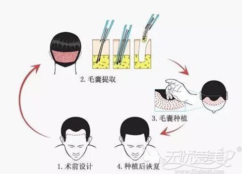 头发种植手术过程