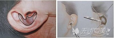 耳软骨隆鼻手术中采用的耳软骨