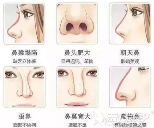 韩国做的隆鼻手术中小翘鼻、水滴鼻、混血鼻有什么区别？