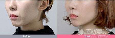 在韩国ID做超声波美肤后的效果对比