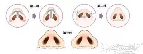 缩小鼻翼的三种方法