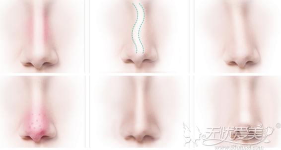 隆鼻修复手术可以改善的鼻型