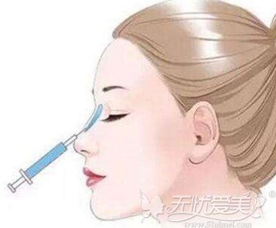 玻尿酸隆鼻手术