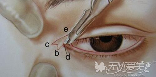 开内眼角手术过程图片