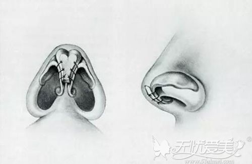 耳软骨垫鼻尖原理