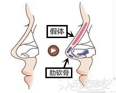 半肋骨隆鼻的手术部位