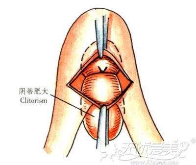 做阴蒂手术会不会影响私密处的敏感度？