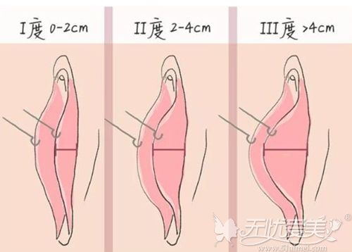 在韩国做小阴唇缩小术不仅能改变形状还能改善颜色 韩国好手艺妇科私密整形医院 无忧爱美网整形医院