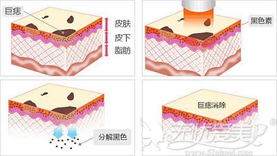 激光去痣的原理解析