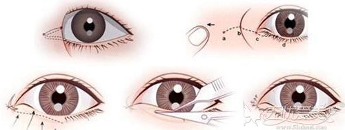 开眼角手术过程