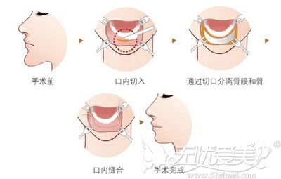 硅胶垫下巴的切口是在口内 所以会导致下唇部分麻木