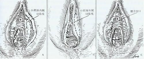 阴唇整形手术过程