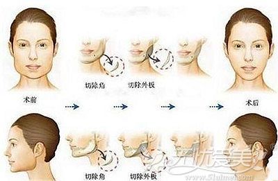 V-line改脸型的手术原理