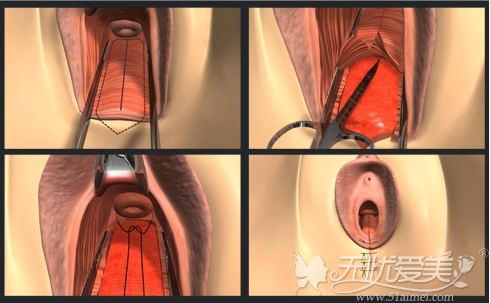 韩国后方膣圆盖术方法