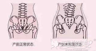 阴道紧缩术前后的对比