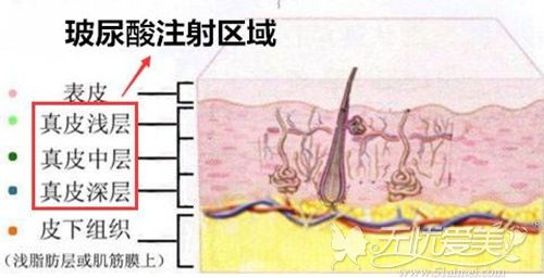 玻尿酸可以注射的区域