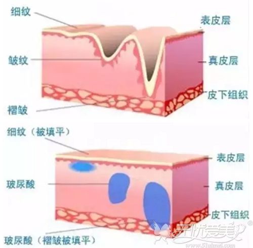 玻尿酸注射的原理