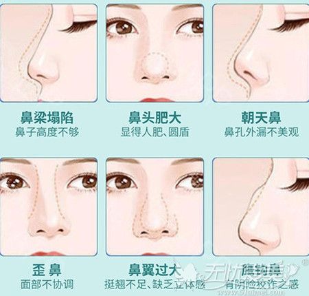 鼻综合手术可以改善的鼻型