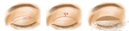 双眼皮手术宽变窄修复过程